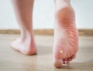 Treatment Options for Plantar Warts