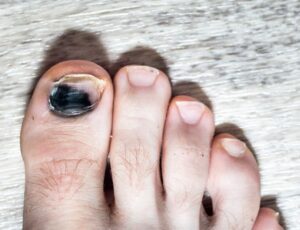 The Mystery of the Black Bruised Toenail