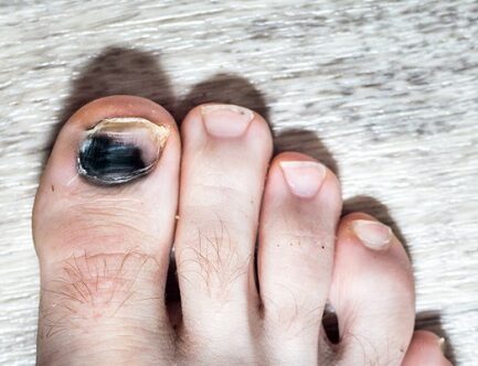 black bruised toenail